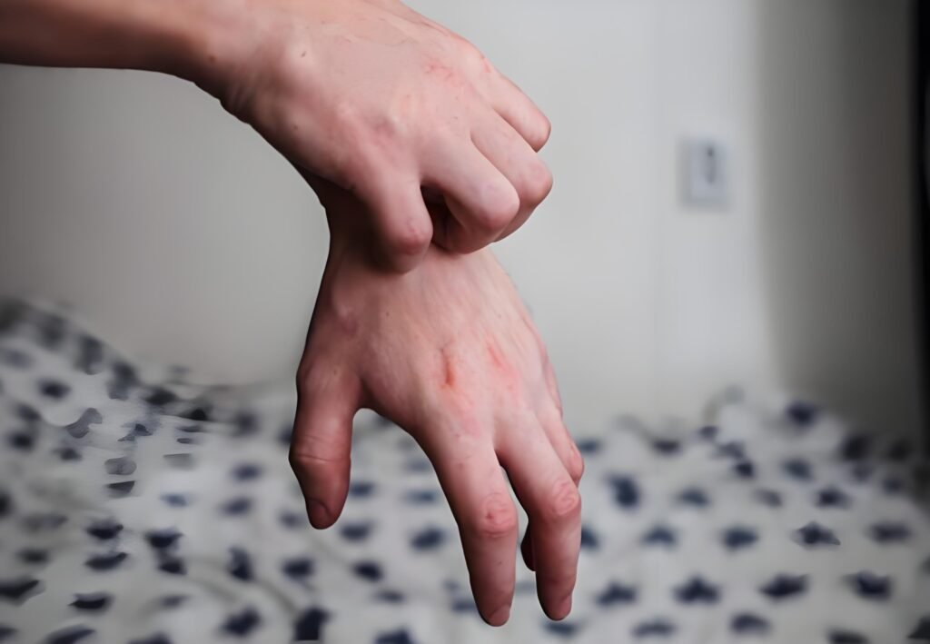 Excoriation Disorder